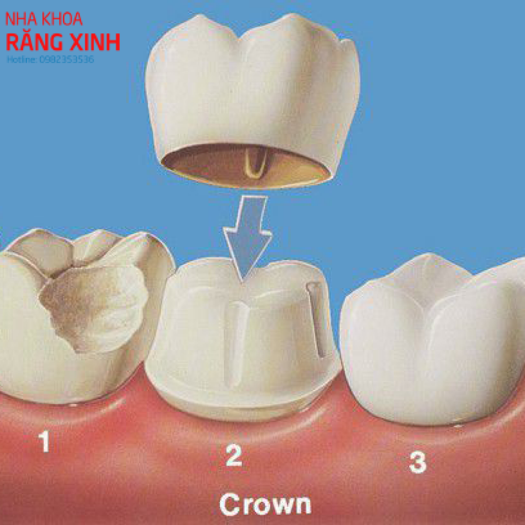 mao rang la gi? phan loai va đia chi boc mao rang uy tin tai vinh