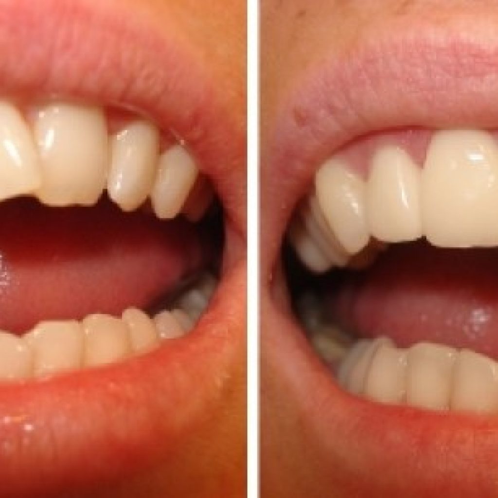 boc rang su la phuong phap tham my tot nhat