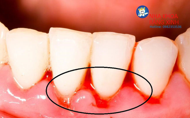 bọc răng sứ giá rẻ