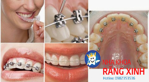 răng mọc lệch