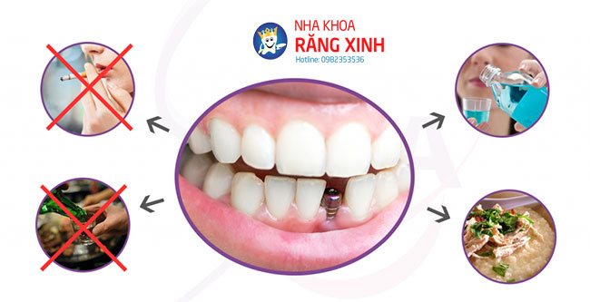 cấy ghép răng implant tại Vinh