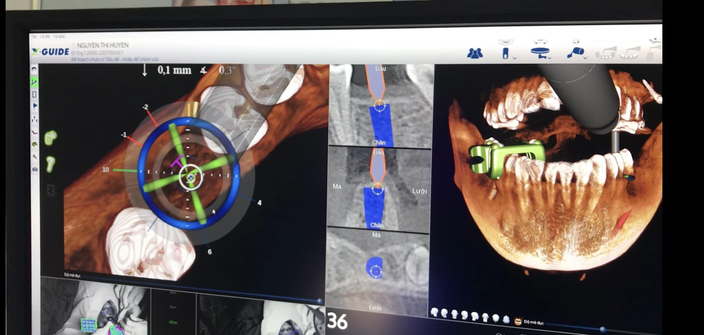 robot đinh vi x-guide trong linh vuc cay ghep implant