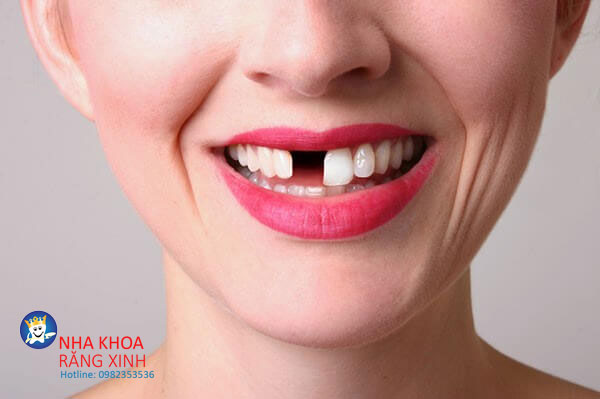 bọc răng sứ giá rẻ