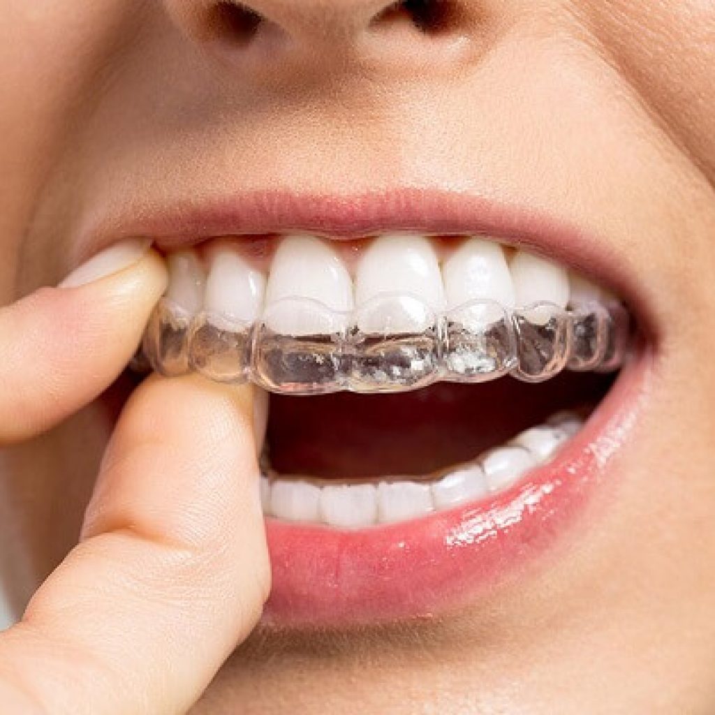 uu nhuoc Điem cua khay nieng rang invisalign trong suot