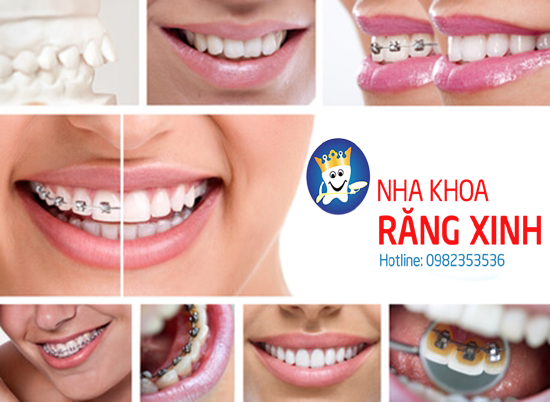 niềng răng giá rẻ