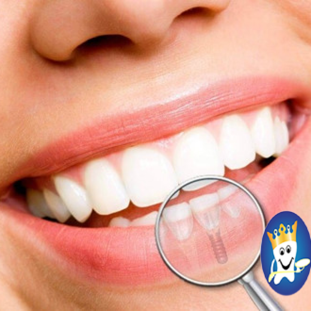 cay ghep rang implant va nhung đieu can luu y!