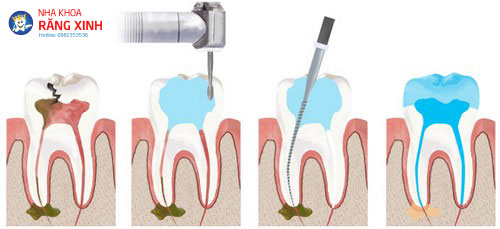 trám răng lấy tủy