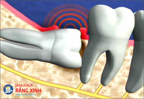 răng mọc lệch