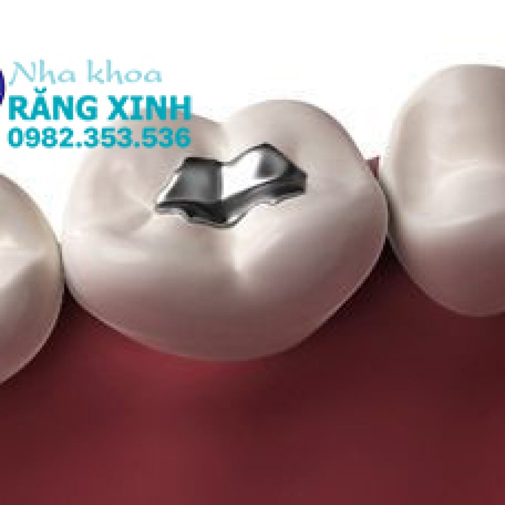 tram rang lay tuy co anh huong gi khong?