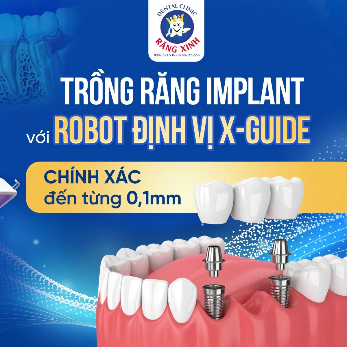 robot đinh vi x-guide trong linh vuc cay ghep implant