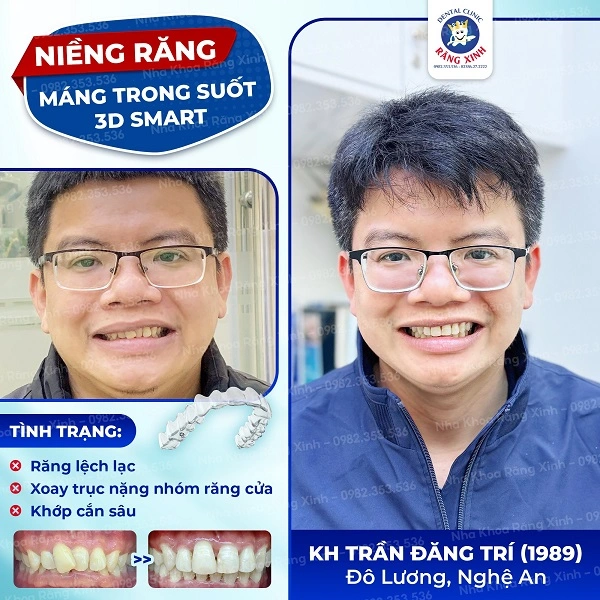 Nha khoa Răng Xinh là địa chỉ niềng răng khay trong suốt 3D Smart uy tín, chất lượng tốt nhất hiện nay