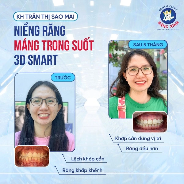Tại Nha khoa Răng Xinh, quy trình niềng răng khay trong suốt 3D Smart được chuẩn hóa theo tiêu chuẩn quốc tế, đảm bảo chính xác – an toàn – tối ưu hiệu quả