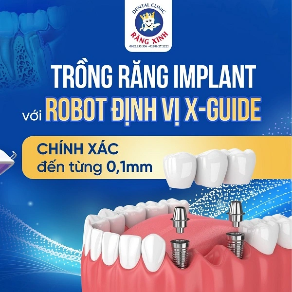 Nha khoa Răng Xinh – Địa chỉ thực hiện dịch vụ trồng răng implant uy tín Nghệ An