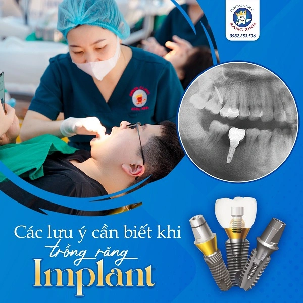 Việc thực hiện đúng các lưu ý trước và sau khi trồng implant sẽ giúp nâng cao tỷ lệ thành công, rút ngắn thời gian hồi phục và đảm bảo răng implant luôn bền chắc