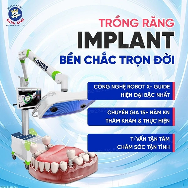 Robot định vị X-Guide được xem là trợ thủ thông minh hiện đại bậc nhất hỗi trợ cấy ghép Implant chính xác đến từng 0,1mm