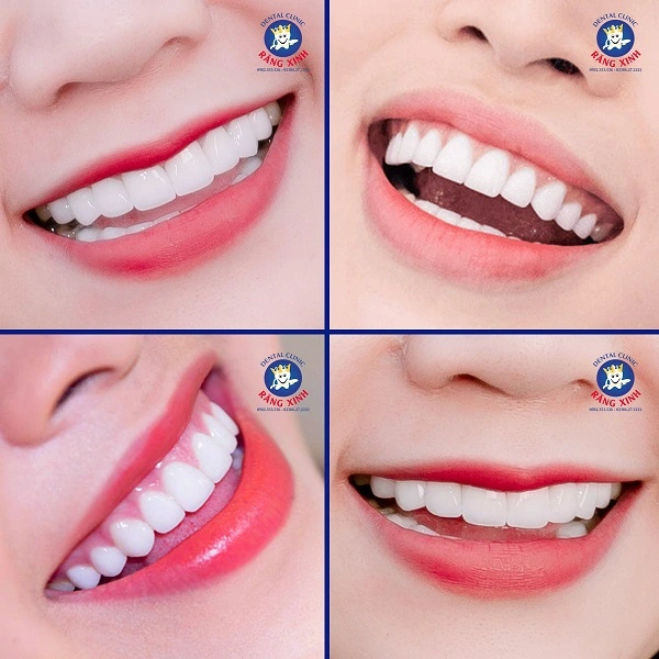 Việc hiểu rõ từng loại răng sứ sẽ giúp bạn lựa chọn được chất liệu phù hợp nhất với nhu cầu thẩm mỹ, tình trạng răng miệng và khả năng tài chính của mình