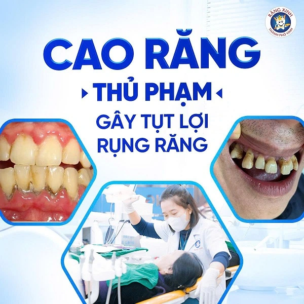 Lấy cao răng không chỉ là bước làm sạch thông thường mà còn là giải pháp quan trọng giúp phòng ngừa viêm nướu, viêm nha chu và nhiều bệnh lý răng miệng khác