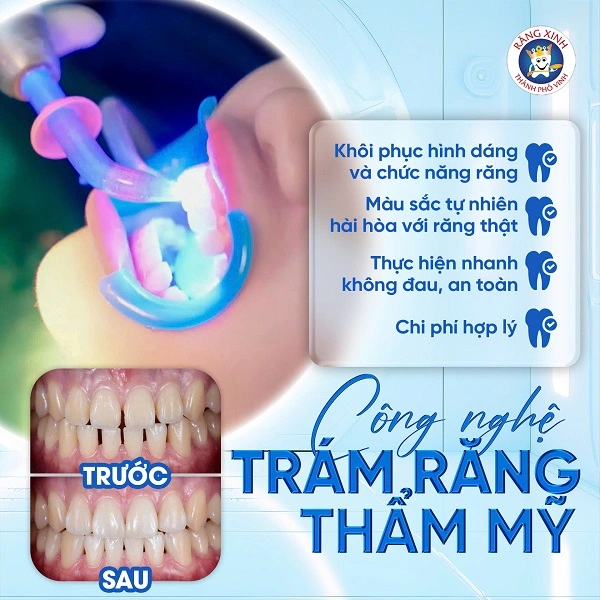 Trám răng thẩm mỹ không chỉ mang lại hiệu quả phục hồi tức thời mà còn đóng vai trò quan trọng trong việc bảo vệ răng thật và duy trì sức khỏe răng miệng về lâu dài