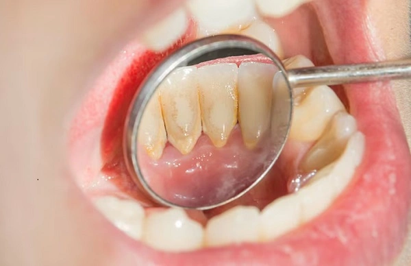 Cao răng thường tích tụ nhiều ở mặt trong răng cửa dưới và mặt ngoài răng hàm trên – nơi tuyến nước bọt hoạt động mạnh