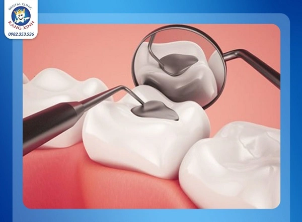 Composite là vật liệu trám răng thẩm mỹ phổ biến nhất hiện nay nhờ khả năng mô phỏng màu sắc răng thật rất tốt