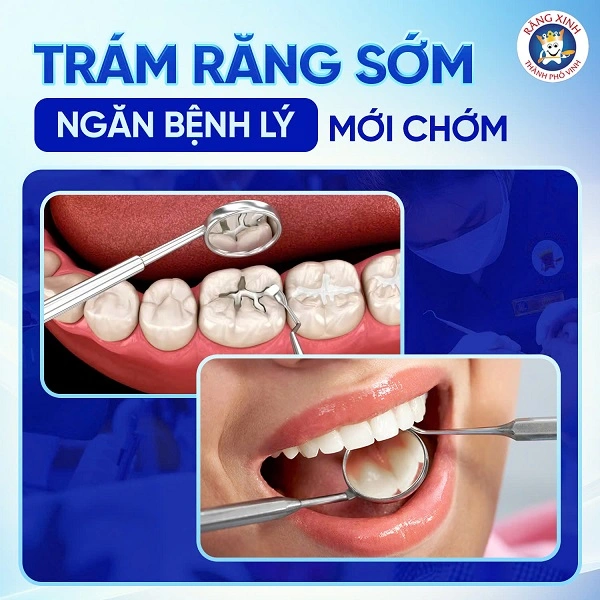 Các vật liệu trám hiện đại được sử dụng để lấp đầy phần răng bị mất, giúp khôi phục lại hình dáng ban đầu