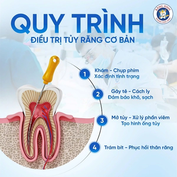 Chữa tủy răng không thể thực hiện một cách qua loa mà cần tuân thủ quy trình chuẩn y khoa với từng bước được kiểm soát chặt chẽ