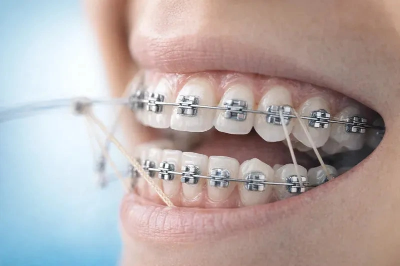 Niềng răng mắc cài là gì và hoạt động như thế nào?