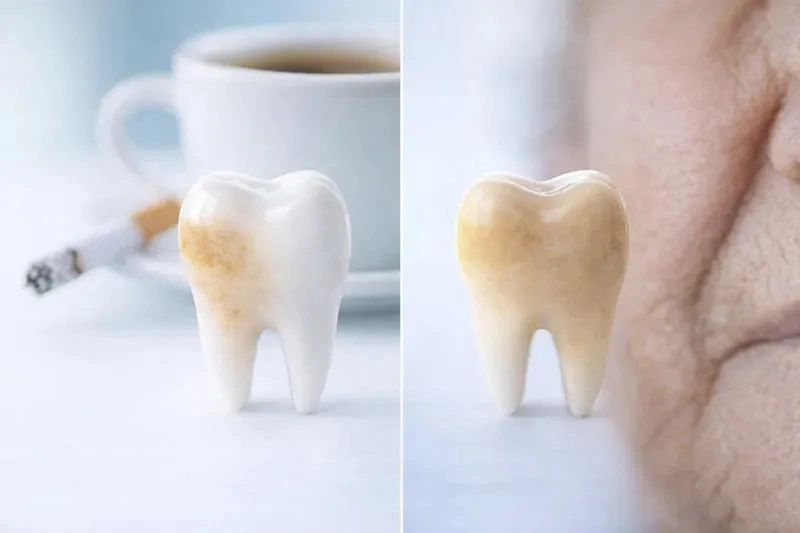 Tẩy trắng răng an toàn là gì? Tiêu chí đánh giá “an toàn”