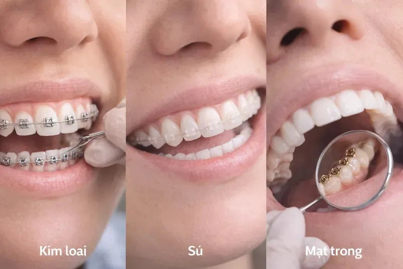 Các loại niềng răng mắc cài phổ biến: kim loại, sứ, mặt trong (lingual)