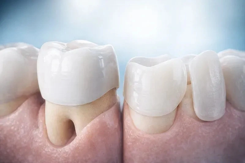 Bọc răng sứ thẩm mỹ là gì? Khác gì dán sứ veneer?